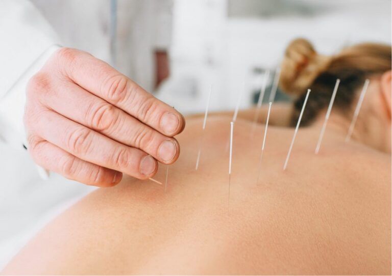 Exploring Dry Needling and Its Benefits