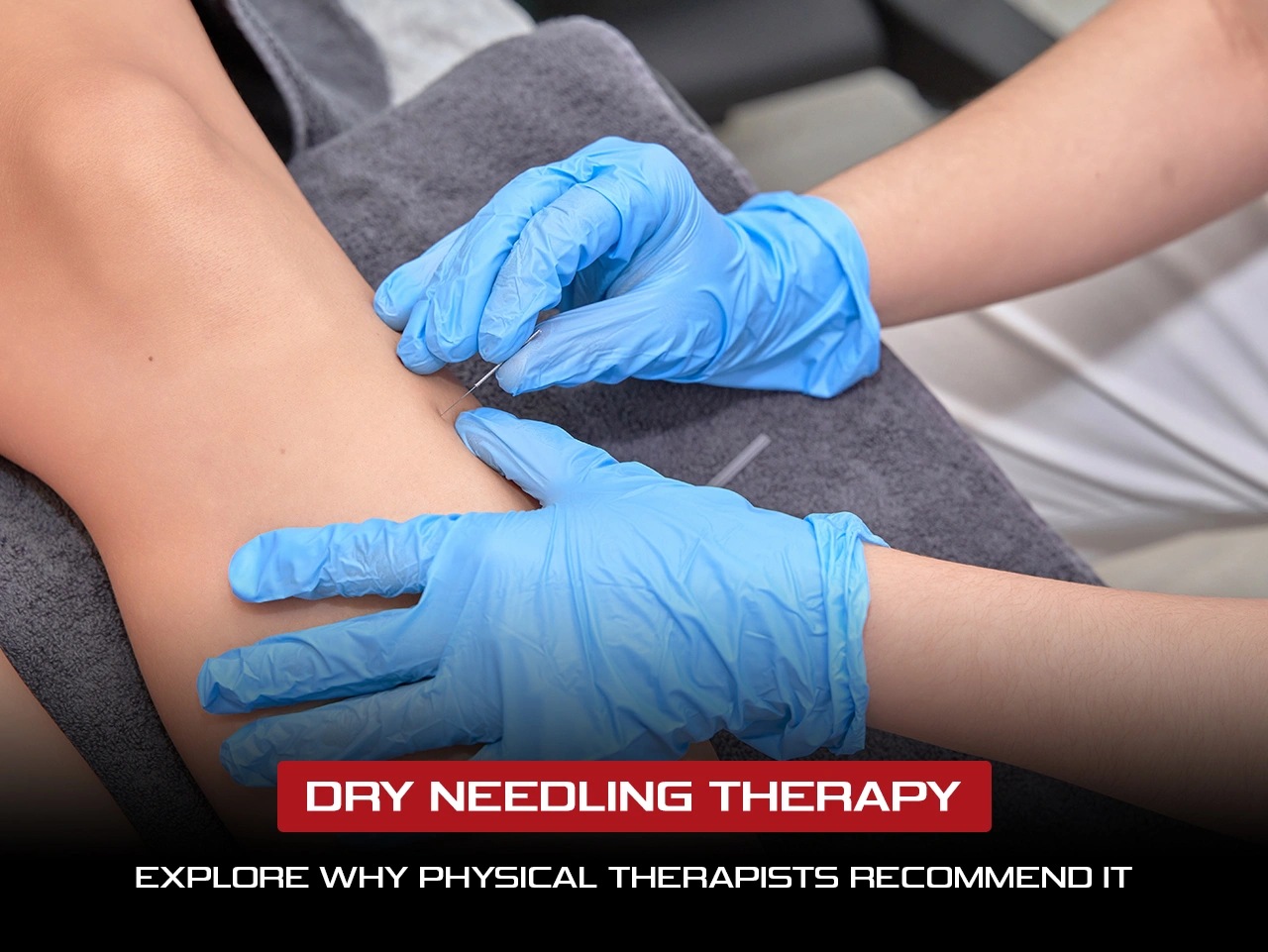 Dry Needling Therapy: Who Needs It Most and Why Physical Therapists Recommend It